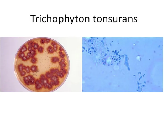 Trichophyton tonsurans