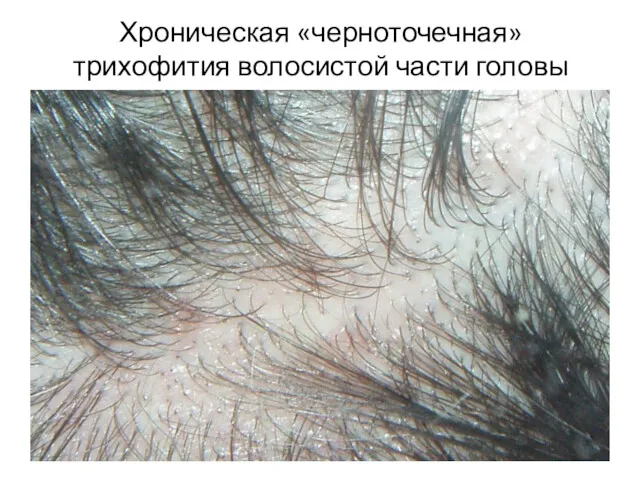 Хроническая «черноточечная» трихофития волосистой части головы