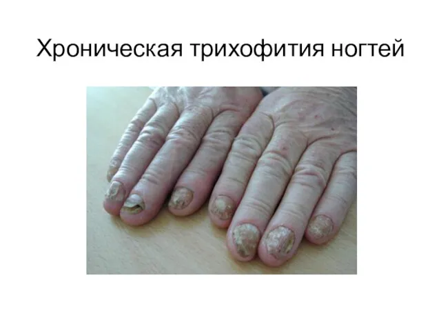 Хроническая трихофития ногтей