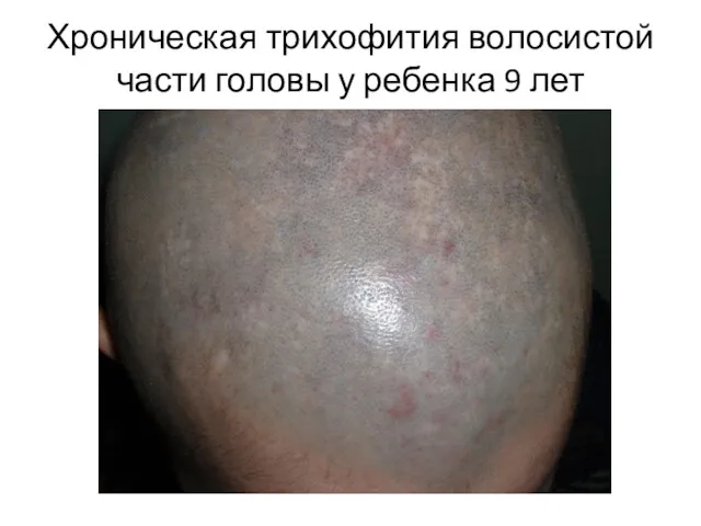 Хроническая трихофития волосистой части головы у ребенка 9 лет