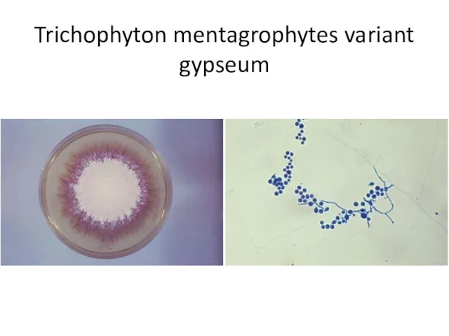 Trichophyton mentagrophytes variant gypseum