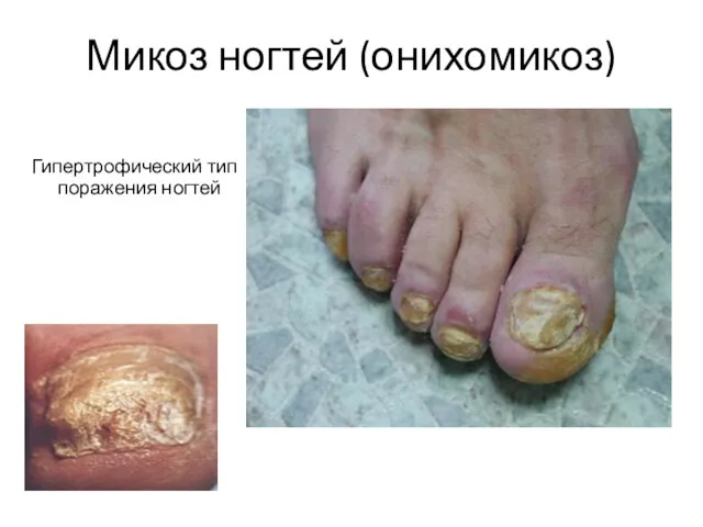 Микоз ногтей (онихомикоз) Гипертрофический тип поражения ногтей