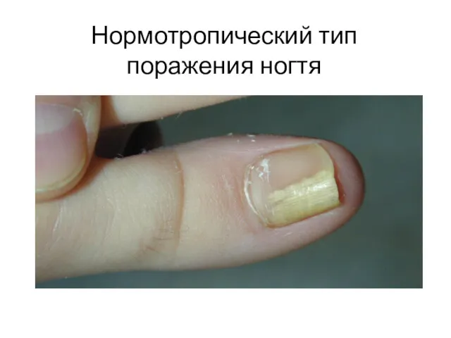 Нормотропический тип поражения ногтя