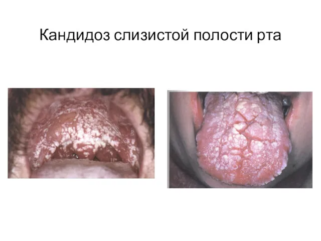 Кандидоз слизистой полости рта