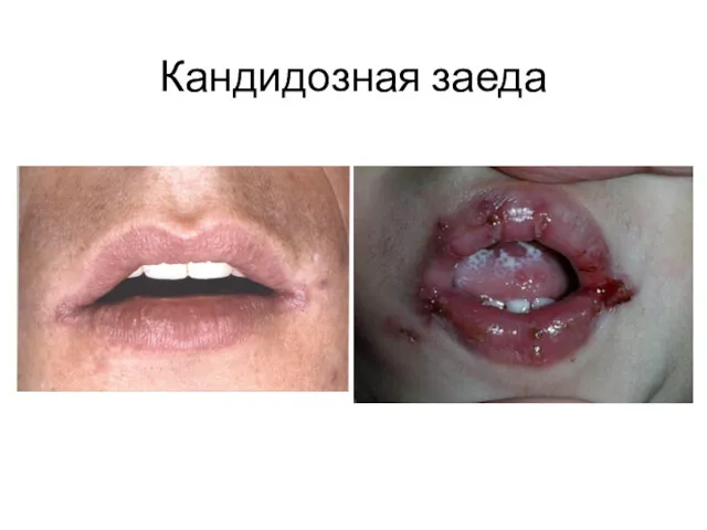 Кандидозная заеда