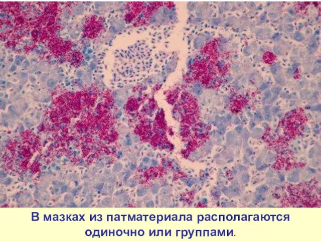 В мазках из патматериала располагаются одиночно или группами.