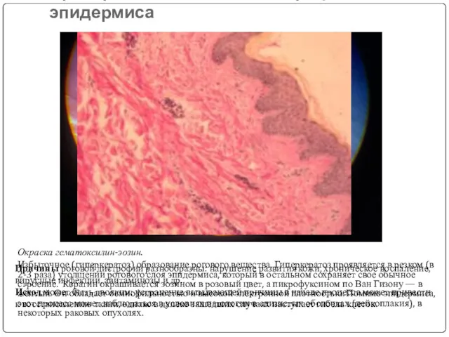 Препарат №42 :Роговая дистрофия эпидермиса Окраска гематоксилин-эозин. Избыточное (гиперкератоз) образование