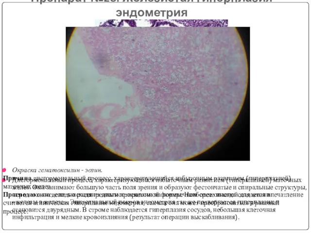 Препарат №28: Железистая гиперплазия эндометрия Окраска гематоксилин - эозин. Дисгормональный