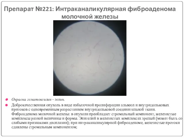 Препарат №221: Интраканаликулярная фиброаденома молочной железы Окраска гематоксилин - эозин.