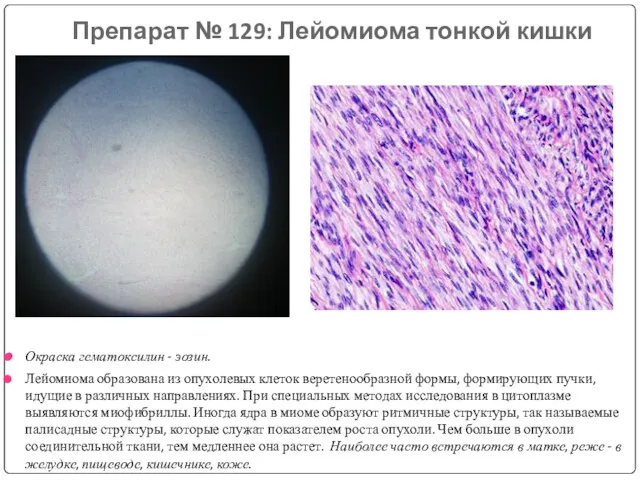 Препарат № 129: Лейомиома тонкой кишки Окраска гематоксилин - эозин.