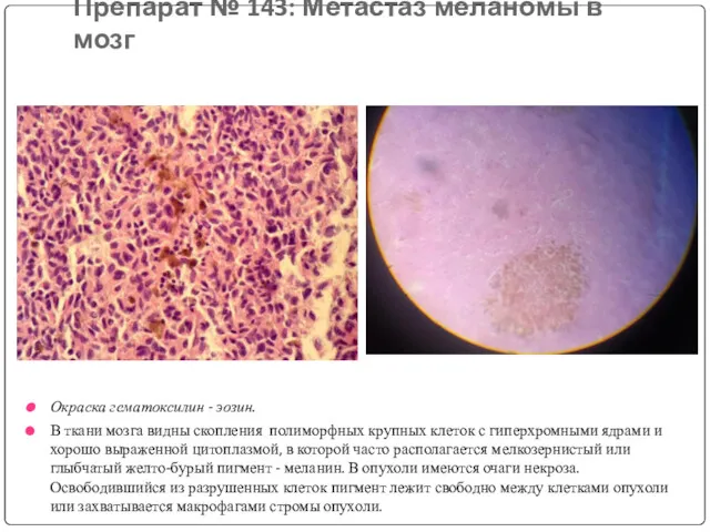 Препарат № 143: Метастаз меланомы в мозг Окраска гематоксилин -