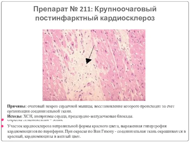 Препарат № 211: Крупноочаговый постинфарктный кардиосклероз Окраска гематоксилин – эозин.