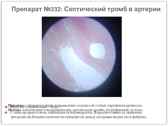 Препарат №232: Септический тромб в артерии Окраска гематоксилин - эозин.
