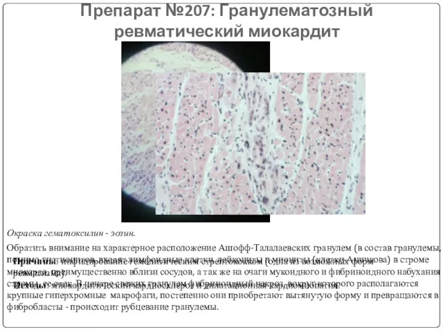 Препарат №207: Гранулематозный ревматический миокардит Окраска гематоксилин - эозин. Обратить