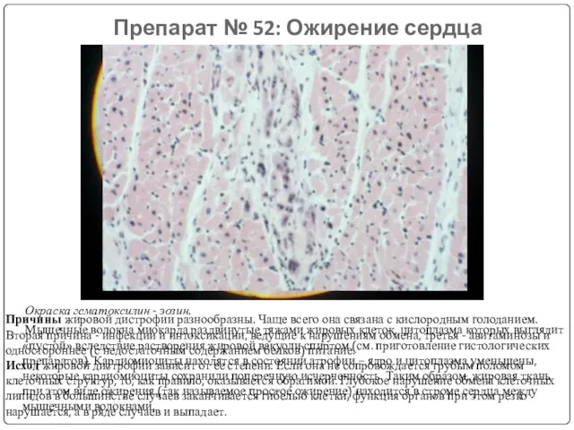 Препарат № 52: Ожирение сердца Окраска гематоксилин - эозин. Мышечные