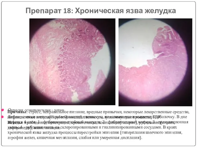 Препарат 18: Хроническая язва желудка Окраска гематоксилин - эозин. Дефект