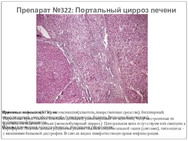 Препарат №322: Портальный цирроз печени Окраска гематоксилин - эозин. Паренхима