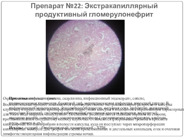 Препарат №22: Экстракапиллярный продуктивный гломерулонефрит Окраска гематоксилин - эозин. Воспалительный