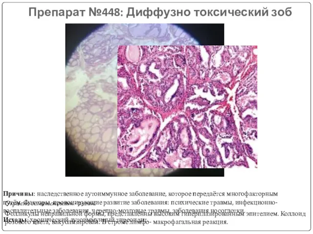 Препарат №448: Диффузно токсический зоб Окраска гематоксилин - эозин. Фолликулы