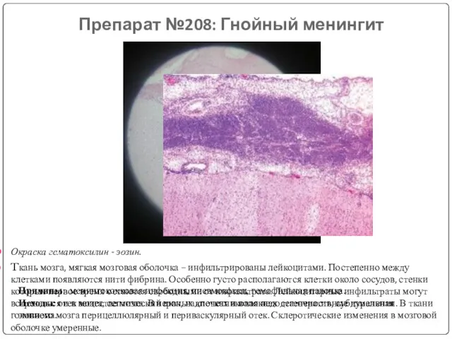 Препарат №208: Гнойный менингит Окраска гематоксилин - эозин. Tкань мозга,