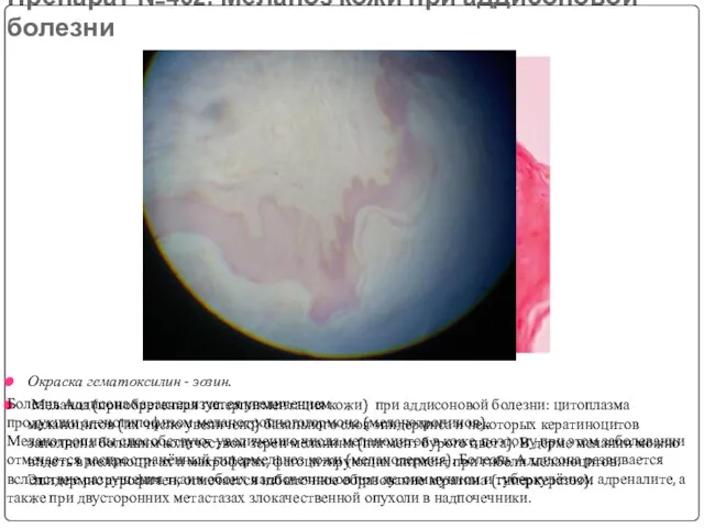 Препарат №402: Меланоз кожи при аддисоновой болезни Окраска гематоксилин -