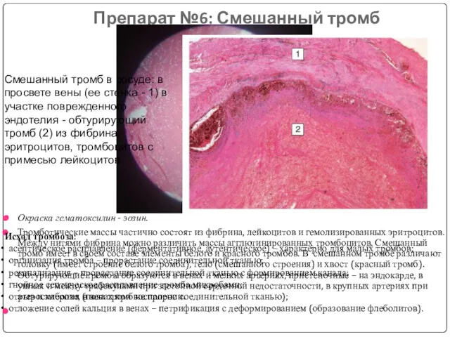 Препарат №6: Смешанный тромб Окраска гематоксилин - эозин. Тромботические массы