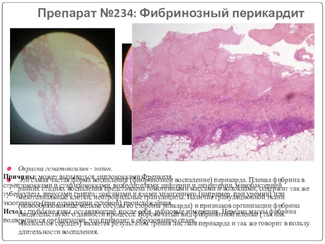 Препарат №234: Фибринозный перикардит Окраска гематоксилин - эозин. Это самая