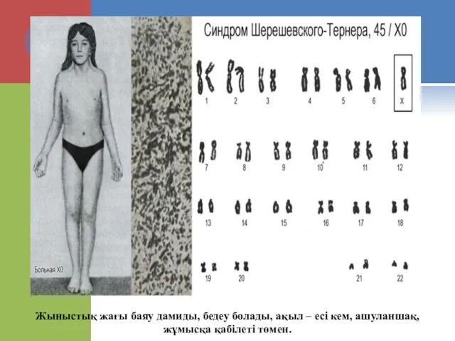 Жыныстық жағы баяу дамиды, бедеу болады, ақыл – есі кем, ашуланшақ,жұмысқа қабілеті төмен.