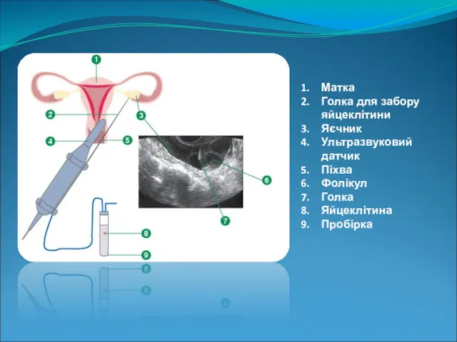 Матка Голка для забору яйцеклітини Яєчник Ультразвуковий датчик Піхва Фолікул Голка Яйцеклітина Пробірка