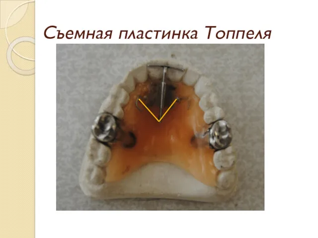 Съемная пластинка Топпеля