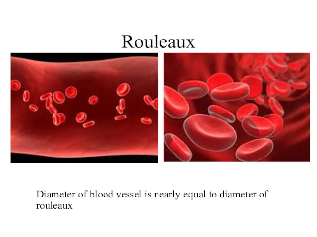 Rouleaux Diameter of blood vessel is nearly equal to diameter of rouleaux