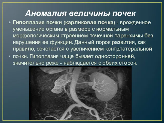Аномалия величины почек Гипоплазия почки (карликовая почка) - врожденное уменьшение органа в размере
