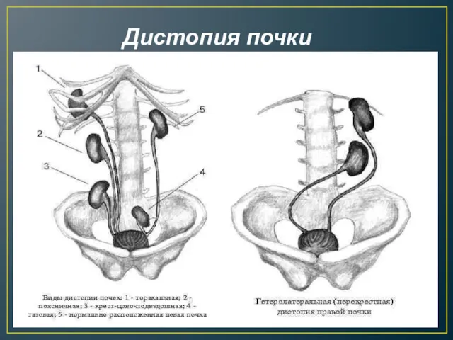 Дистопия почки