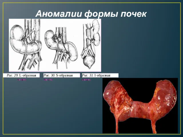 Аномалии формы почек