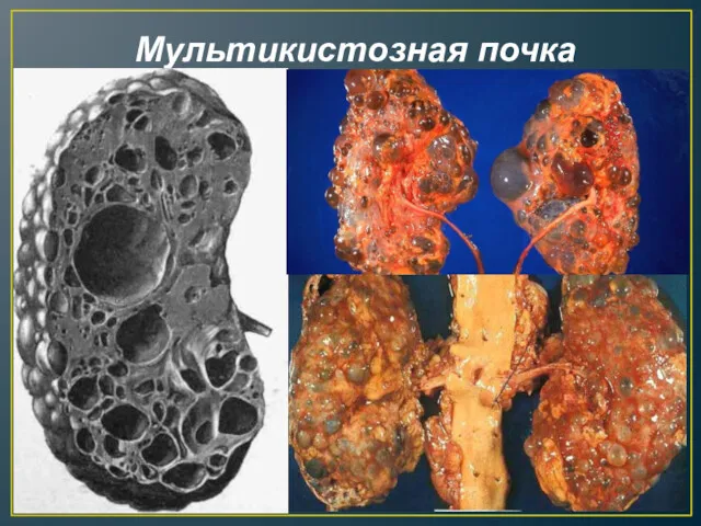 Мультикистозная почка