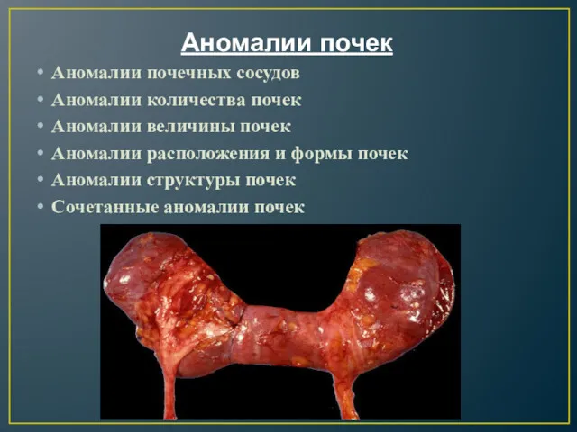 Аномалии почек Аномалии почечных сосудов Аномалии количества почек Аномалии величины