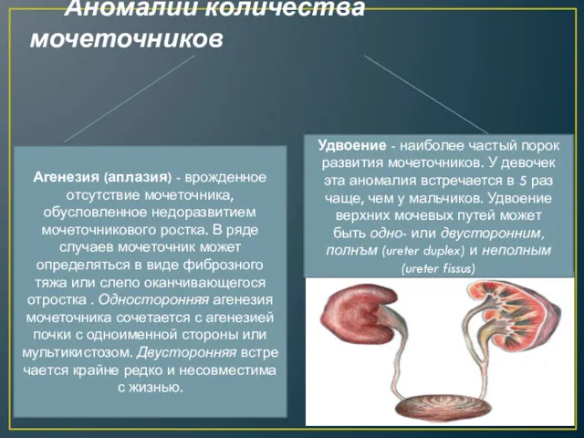 Аномалии количества мочеточников Агенезия (аплазия) - врожденное отсутствие мочеточника, обусловленное