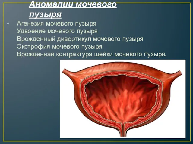 Аномалии мочевого пузыря Агенезия мочевого пузыря Удвоение мочевого пузыря Врожденный