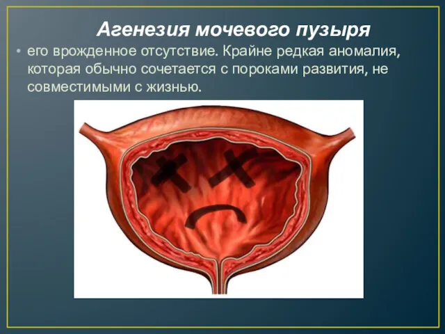 Агенезия мочевого пузыря его врожденное отсутствие. Крайне редкая аномалия, которая