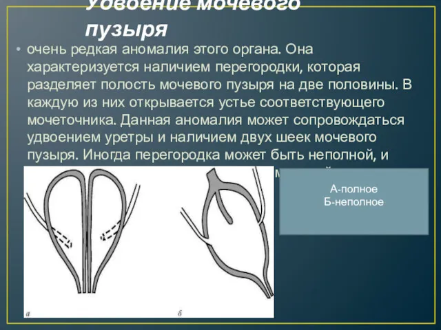 Удвоение мочевого пузыря очень редкая аномалия этого органа. Она характеризуется