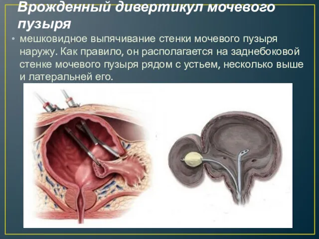 Врожденный дивертикул мочевого пузыря мешковидное выпячивание стенки мочевого пузыря наружу. Как правило, он