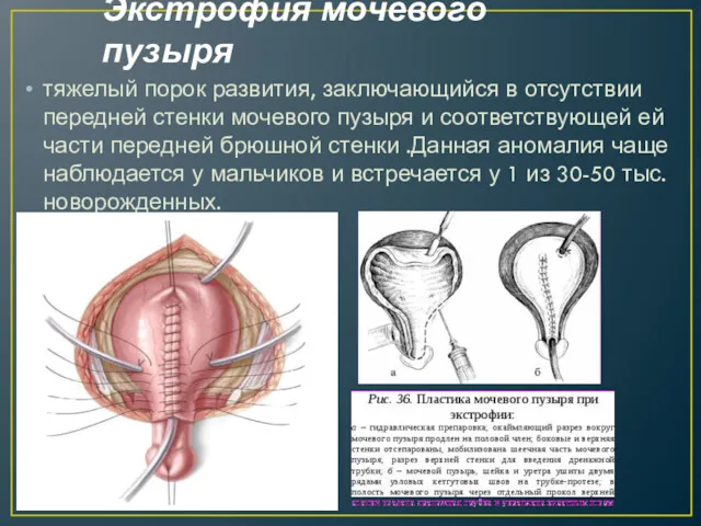 Экстрофия мочевого пузыря тяжелый порок развития, заключающийся в отсутствии передней