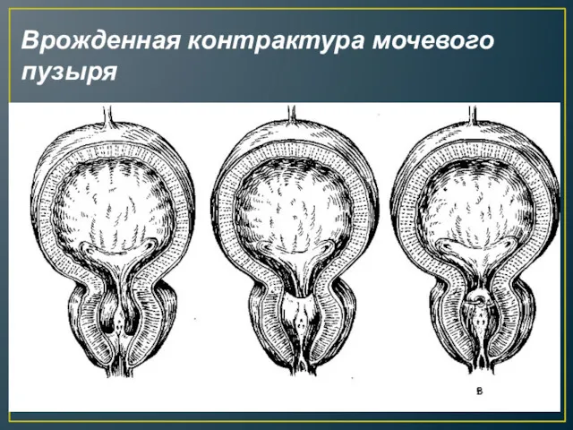 Врожденная контрактура мочевого пузыря
