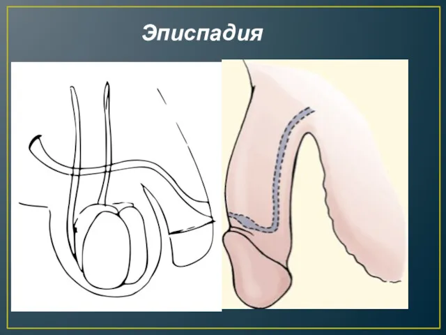 Эписпадия