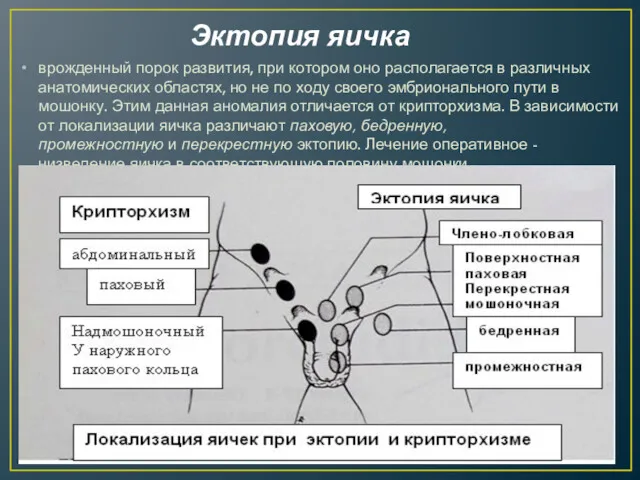 Эктопия яичка врожденный порок развития, при котором оно располагается в