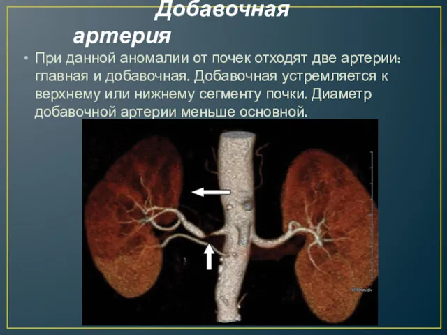 Добавочная артерия При данной аномалии от почек отходят две артерии: главная и добавочная.