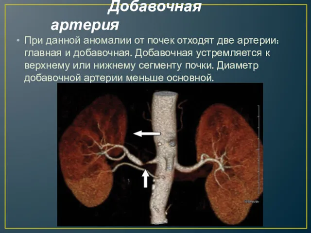 Добавочная артерия При данной аномалии от почек отходят две артерии: