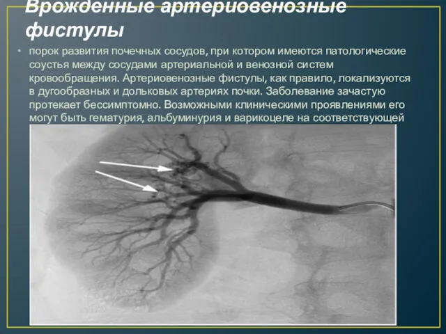 Врожденные артериовенозные фистулы порок развития почечных сосудов, при котором имеются патологические соустья между