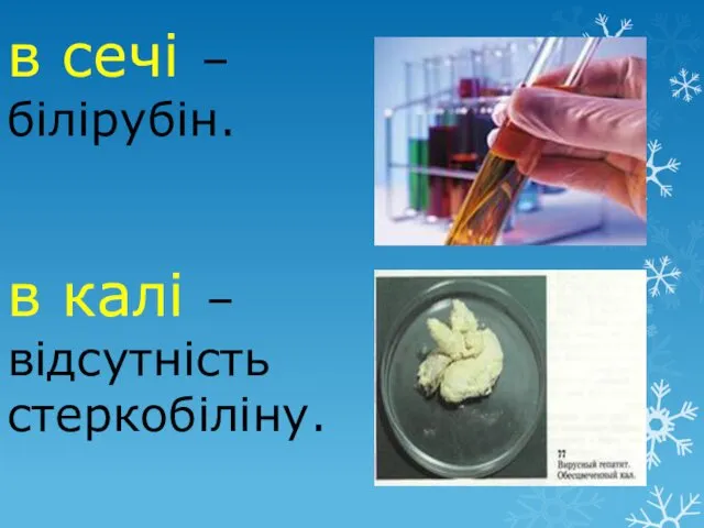 в сечі – білірубін. в калі – відсутність стеркобіліну.