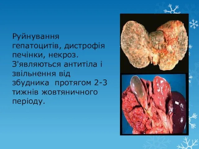 Руйнування гепатоцитів, дистрофія печінки, некроз. З'являються антитіла і звільнення від збудника протягом 2-3 тижнів жовтяничного періоду.